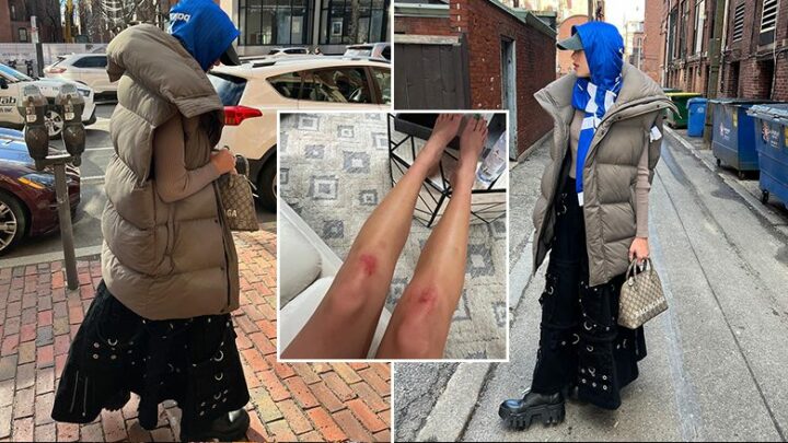 (VIDEO) Dua Lipa tregon mavijosjet në gjunjët e saj gjatë shfaqjes në Boston